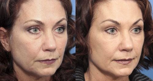 Facial Fillers Before & After Gallery - Patient 58214206 - Image 2