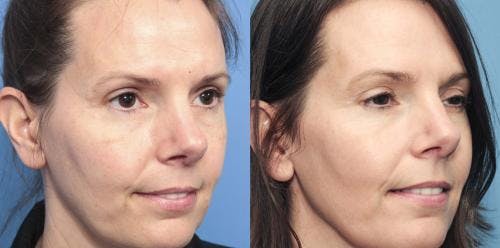 IPL Before & After Gallery - Patient 58214207 - Image 2