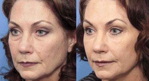 Facial Fillers Before & After Gallery - Patient 58214206 - Image 3