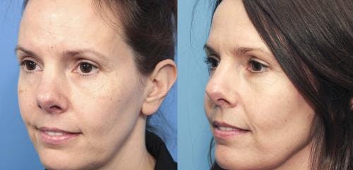 IPL Before & After Gallery - Patient 58214207 - Image 3