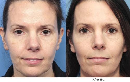 IPL Before & After Gallery - Patient 58214207 - Image 1