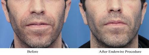 Facial Fillers Before & After Gallery - Patient 58214208 - Image 1