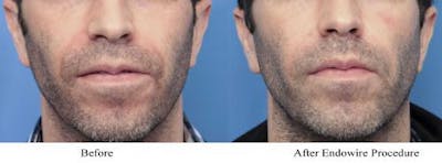Facial Fillers Before & After Gallery - Patient 58214208 - Image 1