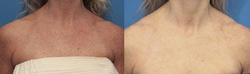 IPL Before & After Gallery - Patient 58214209 - Image 1