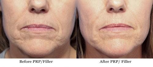 Facial Fillers Before & After Gallery - Patient 58214210 - Image 1