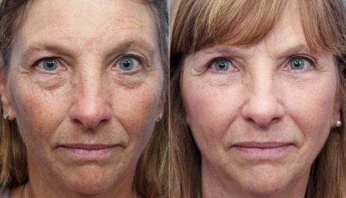 IPL Before & After Gallery - Patient 58214212 - Image 1
