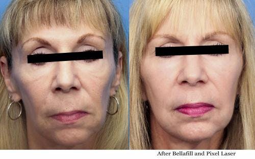 Facial Fillers Before & After Gallery - Patient 58214213 - Image 1