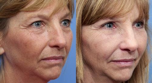 IPL Before & After Gallery - Patient 58214212 - Image 3