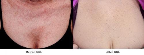 IPL Before & After Gallery - Patient 58214214 - Image 1