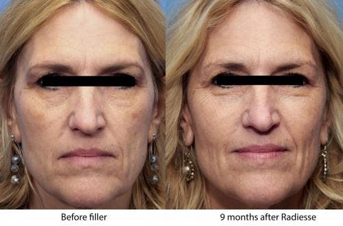 Facial Fillers Before & After Gallery - Patient 58214215 - Image 1
