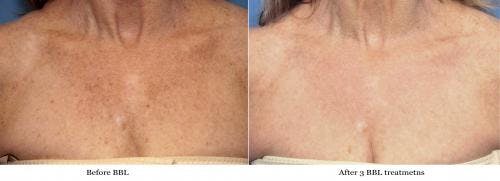 IPL Before & After Gallery - Patient 58214216 - Image 1
