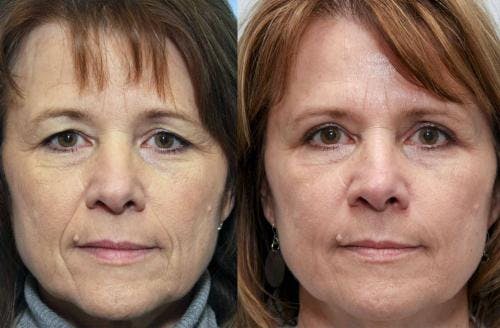 Facial Fillers Before & After Gallery - Patient 58214217 - Image 1