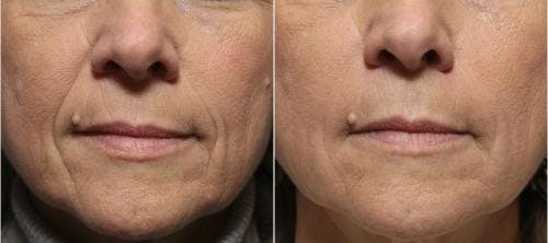 Facial Fillers Before & After Gallery - Patient 58214217 - Image 2