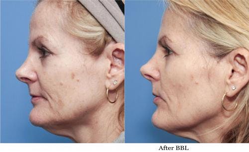 IPL Before & After Gallery - Patient 58214218 - Image 2