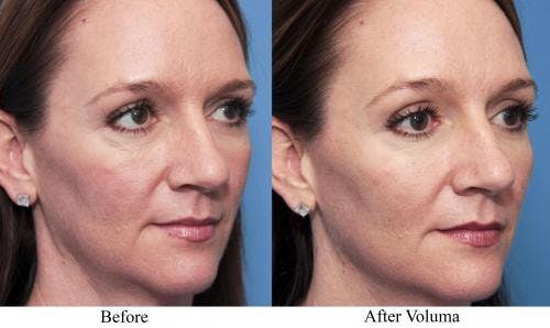 Facial Fillers Before & After Gallery - Patient 58214220 - Image 1