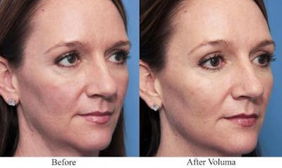 Facial Fillers Before & After Gallery - Patient 58214220 - Image 1