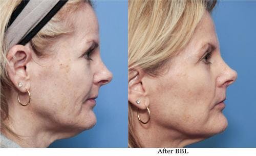 IPL Before & After Gallery - Patient 58214218 - Image 1
