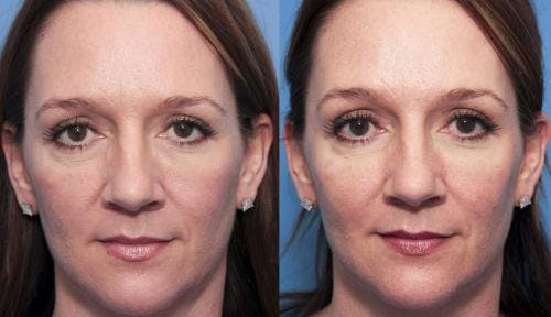 Facial Fillers Before & After Gallery - Patient 58214220 - Image 2