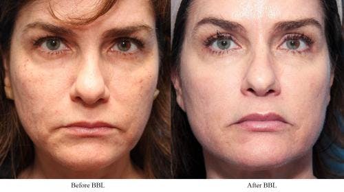 IPL Before & After Gallery - Patient 58214222 - Image 1