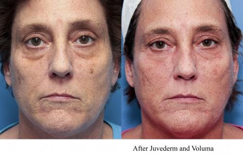 Facial Fillers Before & After Gallery - Patient 58214221 - Image 1