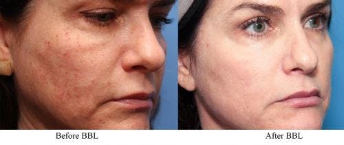 IPL Before & After Gallery - Patient 58214222 - Image 2