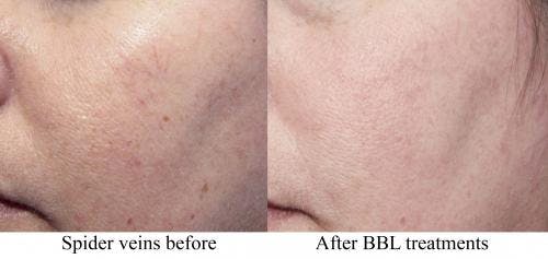IPL Before & After Gallery - Patient 58214224 - Image 1