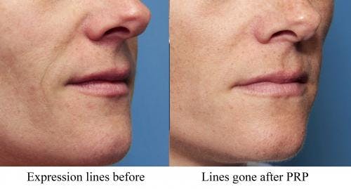 Facial Fillers Before & After Gallery - Patient 58214223 - Image 1