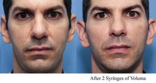 Facial Fillers Before & After Gallery - Patient 58214225 - Image 1
