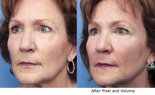 Facial Fillers Before & After Gallery - Patient 58214229 - Image 1