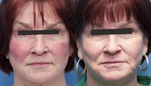 IPL Before & After Gallery - Patient 58214227 - Image 1