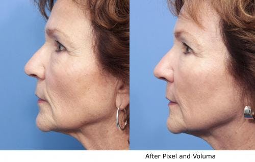 Facial Fillers Before & After Gallery - Patient 58214229 - Image 2
