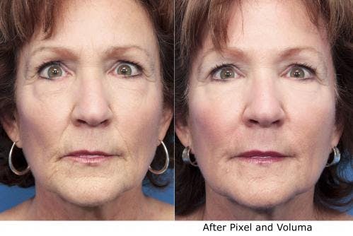 Facial Fillers Before & After Gallery - Patient 58214229 - Image 3