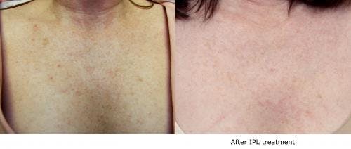 IPL Before & After Gallery - Patient 58214228 - Image 1
