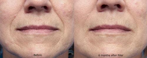 Facial Fillers Before & After Gallery - Patient 58214231 - Image 1