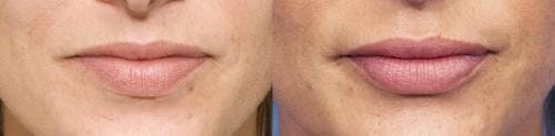 Lip Augmentation