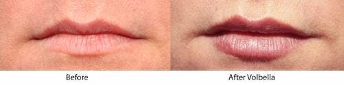 Lip Augmentation Before & After Gallery - Patient 58214241 - Image 1
