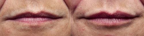 Lip Augmentation Before & After Gallery - Patient 58214244 - Image 1