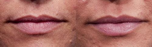 Lip Augmentation Before & After Gallery - Patient 58214245 - Image 1