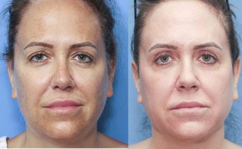 Laser Treatments Before & After Gallery - Patient 58214248 - Image 1