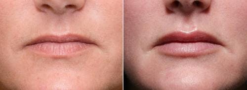 Lip Augmentation Before & After Gallery - Patient 58214246 - Image 1