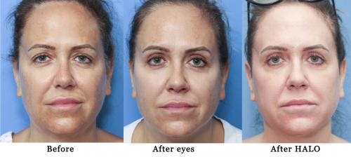 Laser Treatments Before & After Gallery - Patient 58214248 - Image 2