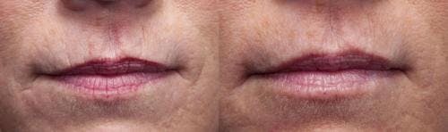 Lip Augmentation Before & After Gallery - Patient 58214247 - Image 1
