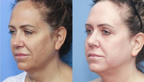 Laser Treatments Before & After Gallery - Patient 58214248 - Image 3