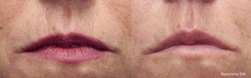 Lip Augmentation Before & After Gallery - Patient 58214249 - Image 1