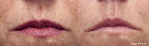 Lip Augmentation Before & After Gallery - Patient 58214249 - Image 1