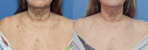 Laser Treatments Before & After Gallery - Patient 58214250 - Image 1