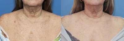 Laser Treatments Before & After Gallery - Patient 58214250 - Image 1