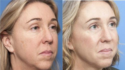 Laser Treatments Before & After Gallery - Patient 58214252 - Image 1