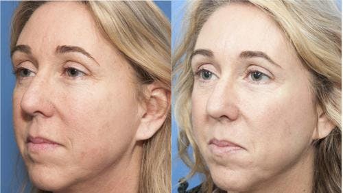Laser Treatments Before & After Gallery - Patient 58214252 - Image 2