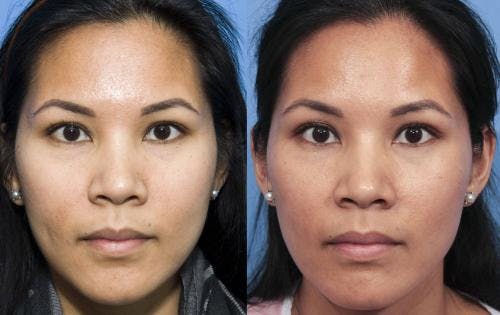 Laser Treatments Before & After Gallery - Patient 58214259 - Image 1